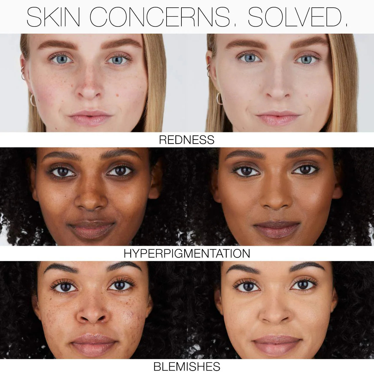Before and after results showing NARS Natural Radiant Longwear Foundation covering redness, hyperpigmentation, and blemishes