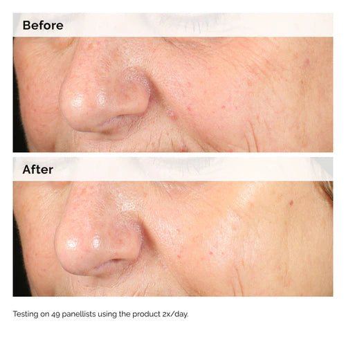 مقارنة قبل وبعد على منطقة الأنف والخد بعد استخدام The Ordinary Alpha Arbutin 2% + HA لتحسين مظهر البشرة