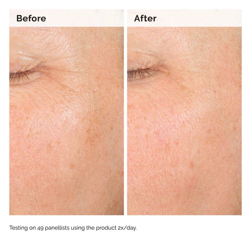 مقارنة قبل وبعد على بشرة الوجه بعد استخدام The Ordinary Alpha Arbutin 2% + HA لتوحيد المظهر
