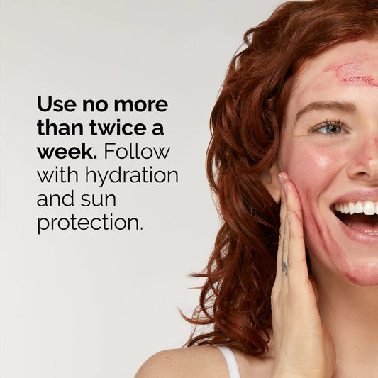 The Ordinary AHA 30% + BHA 2% Peeling Solution – محلول تقشير قوي لإشراقة البشرة