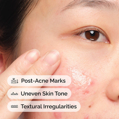 The Ordinary Aloe 2% + NAG 2% Solution – سيروم لآثار ما بعد الحبوب