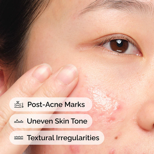 The Ordinary Aloe 2% + NAG 2% Solution – سيروم لآثار ما بعد الحبوب